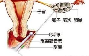 稽留流产史在厦门安宝医院做三代试管十五万够吗？钱都花到了哪些地方
